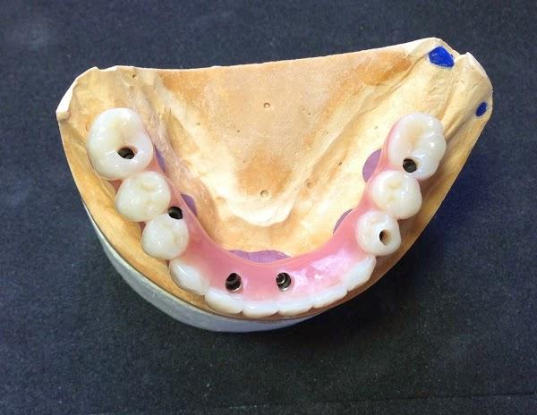 Imagen 11 BOSPRODEN, Bosch Protesis Dental foto