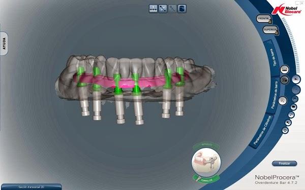 Imagen 12 BOSPRODEN, Bosch Protesis Dental foto