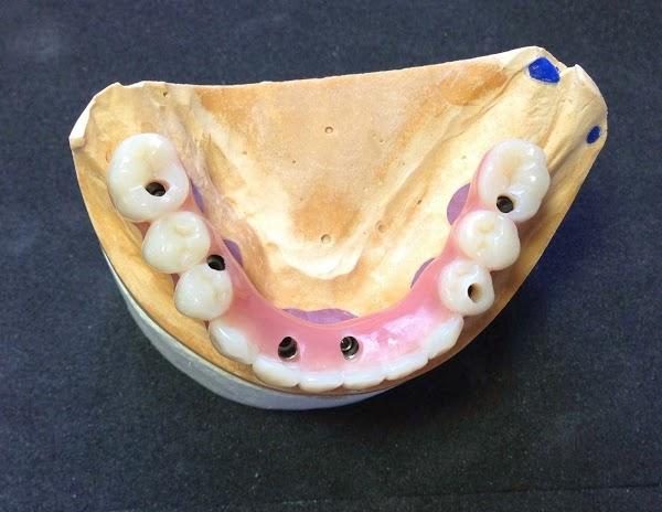 Imagen 22 BOSPRODEN, Bosch Protesis Dental foto